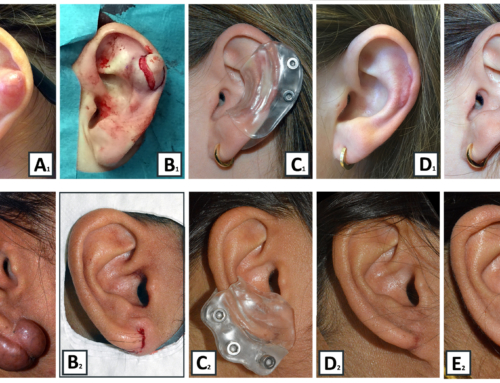 Evaluatie van een combinatie-therapie voor recidiverend auriculair keloid.