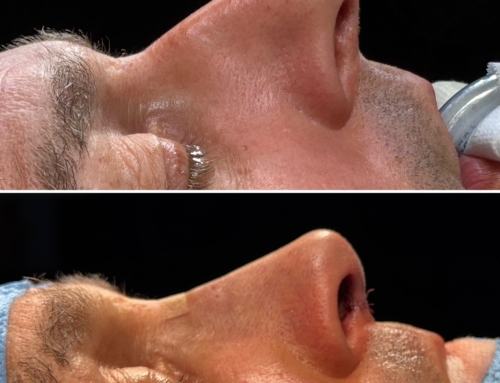 Dorsal preservation rhinoplasty en precision rhinoplasty