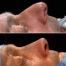 dorsal preservation rhinoplasty
