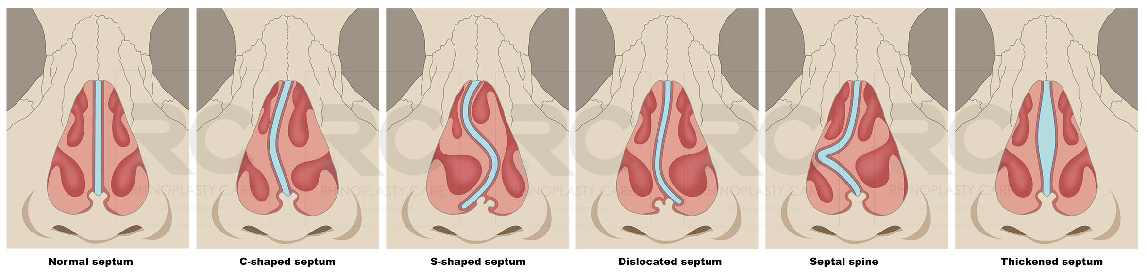 soorten septumdeviatie