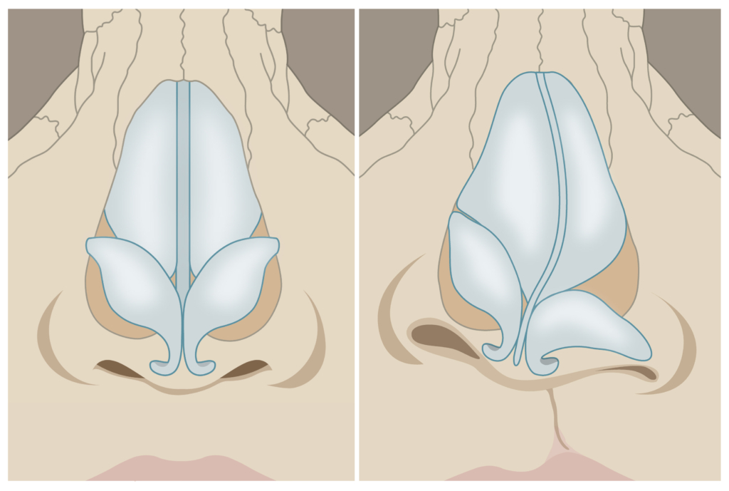 schisis enkelzijdig frontaal anatomie Datema