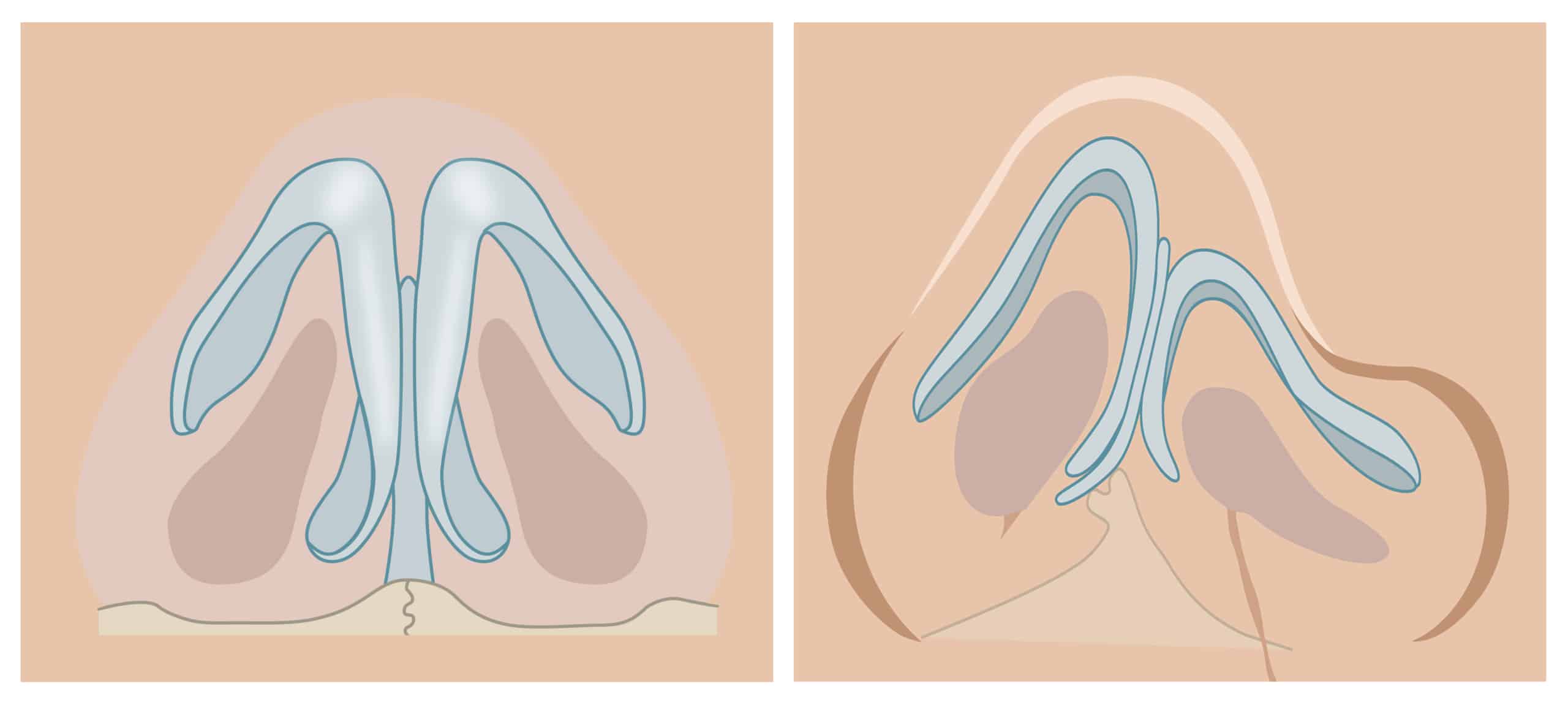 enkelzijdige schisis anatomie neus Datema